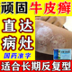 疗癣卡西甫散治疗顽固牛皮癣银屑病中药皮肤瘙痒专用止痒药口服药