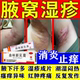 治腋下湿疹发痒腋窝淹红肿痛毛囊炎出汗多红疹瘙痒止痒曲咪新乳膏
