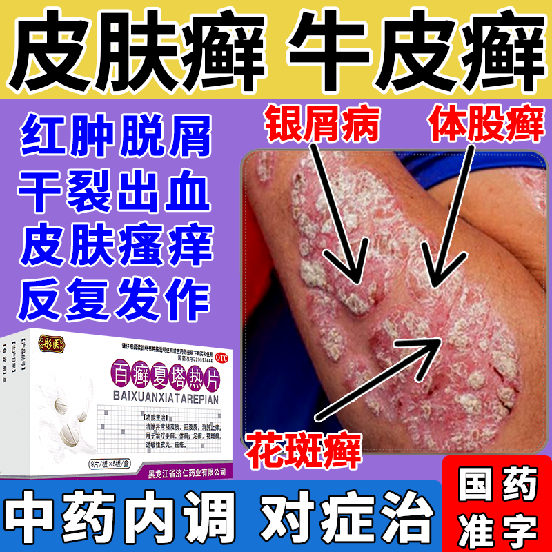百癣夏塔热片治疗顽固牛皮癣药银屑病手癣足癣体癣花斑癣皮肤瘙痒