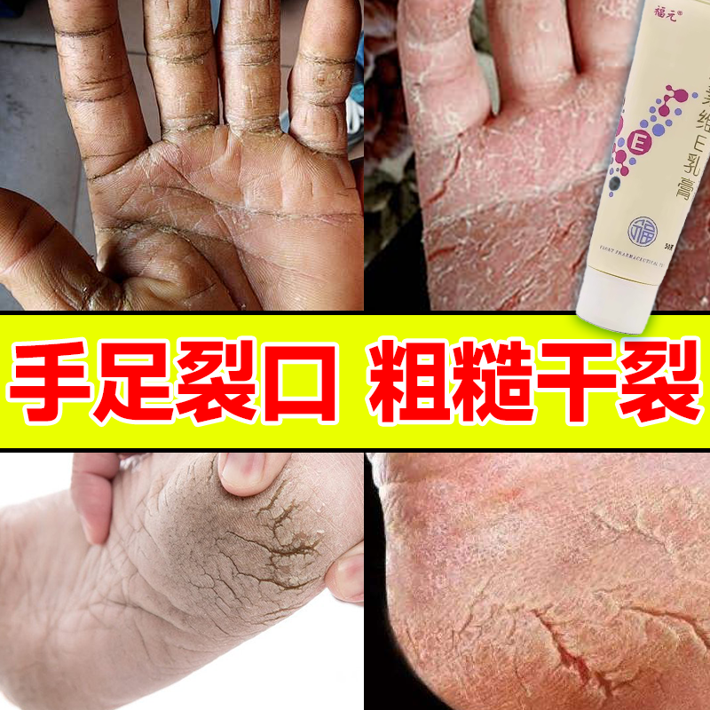 尿素维e乳膏|手足皲裂干裂冻疮护手霜