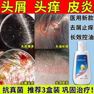 康王酮康唑洗剂去屑止痒洗发水头皮屑严重去头屑药脂溢性皮炎正品