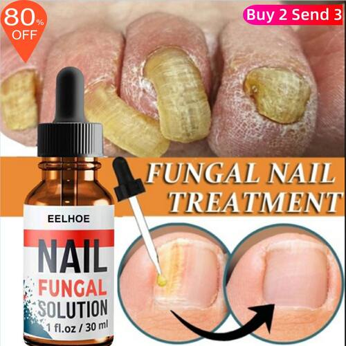 极速Foot Finger Liquid Anti Fungal Repair Serum Nail Removal