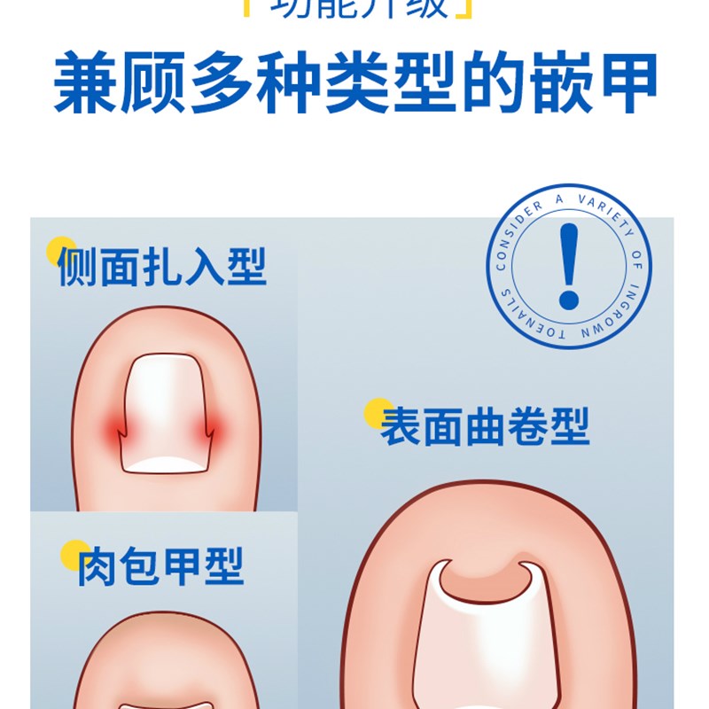 甲沟炎神器指甲矫正器嵌甲专用隔离纠正工具脚趾甲往肉里长纠正甲