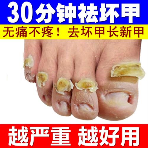 脱甲液去坏指甲增厚无痛精油脱甲膏软甲液抑N菌液灰甲净专用指甲