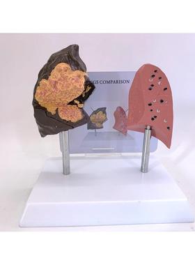 人体吸烟肺与健康肺对比模型 病理肺 肺泡解剖肺呼吸系统病变肺