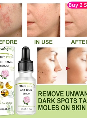 Wart Mole Remover Liquid Non-marking Organic Tags Serum Skin