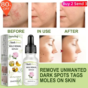 Liquid Non Serum Mole Skin Tags Remover Organic Wart marking