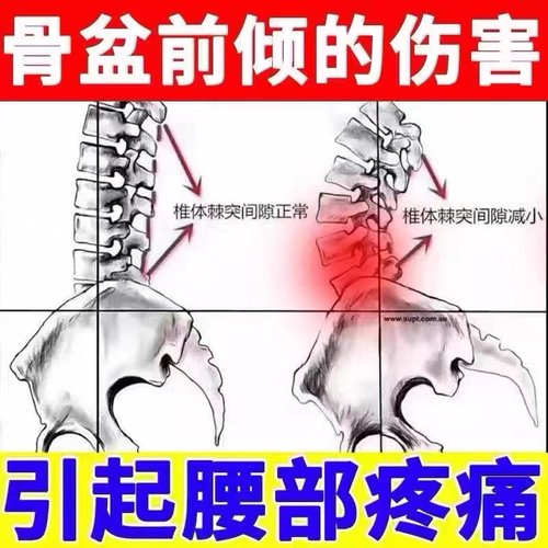 【一贴矫正】骨盆修复矫正盆骨前倾后倾产后改善收胯假胯宽神器LM