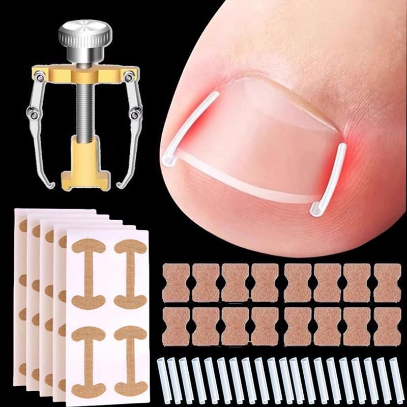 大脚趾指甲矫正器甲沟嵌甲