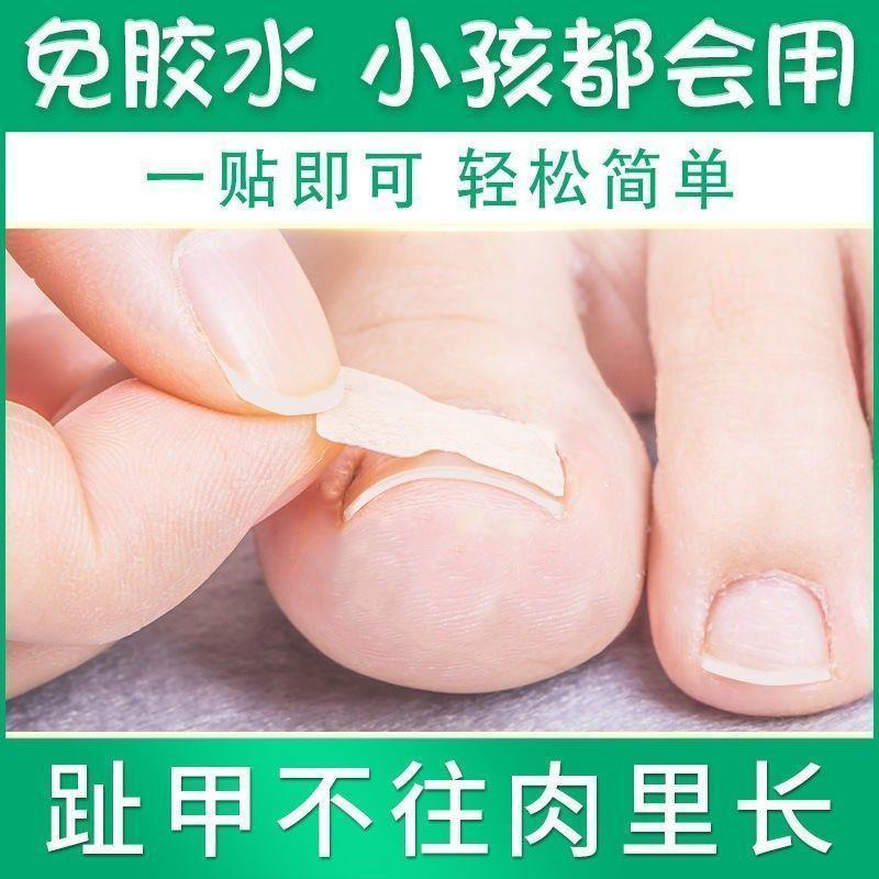 大脚趾指甲矫正器甲沟炎矫