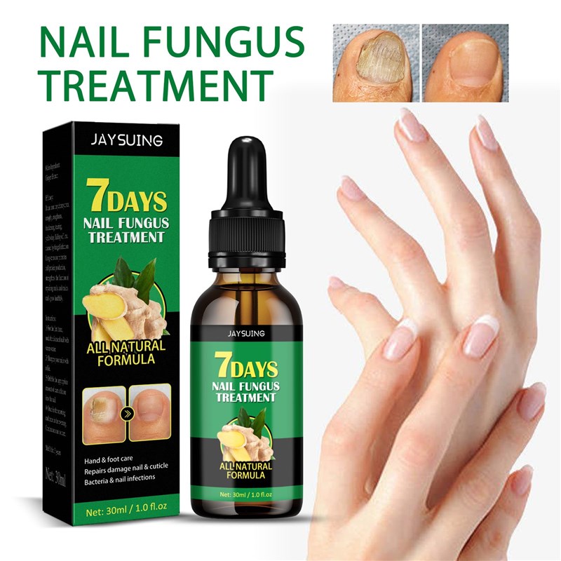 Ginger Nail Fungal Treatment Feet Essence Anti Infection