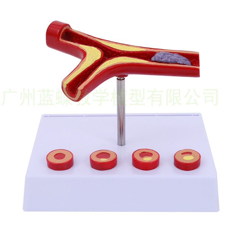 人体支脉硬化粥样 心血管硬化动脉模型 血全模型人体血管模型