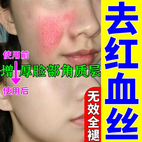 面油男士去红血丝角质层薄修复大红色脸敏感修复脸上有红血丝怎麽