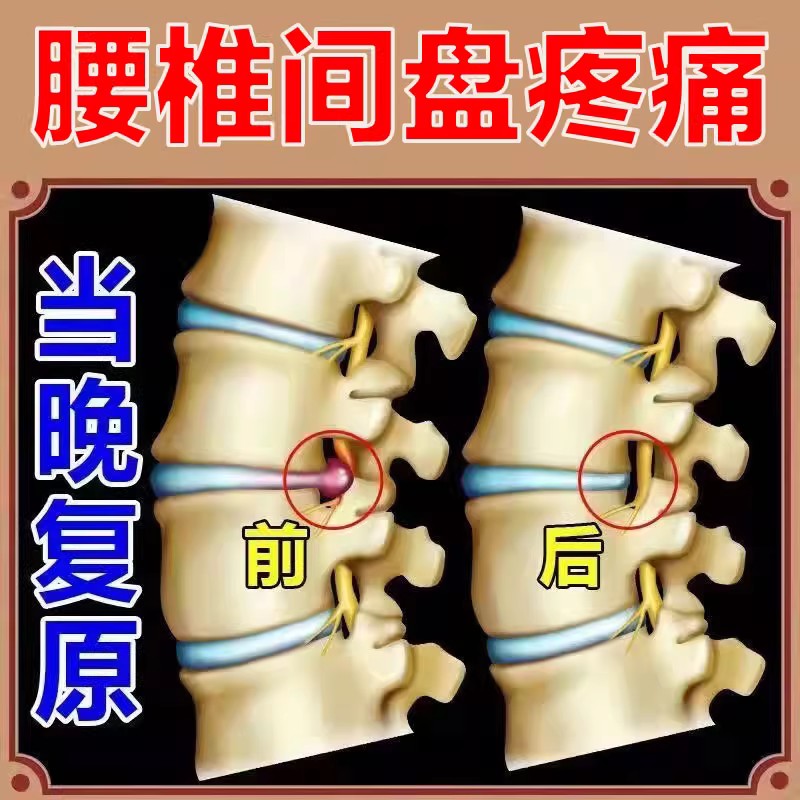 【当晚复原】腰锥间盘突出腰部疼痛直不起腰腰椎部位型腰椎贴YX