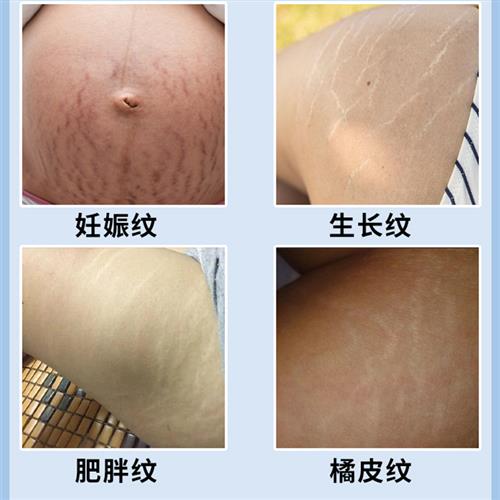 妊辰纹消除去妊娠纹产後消除紧致祛除肥胖纹生长纹遮挡淡化修复霜