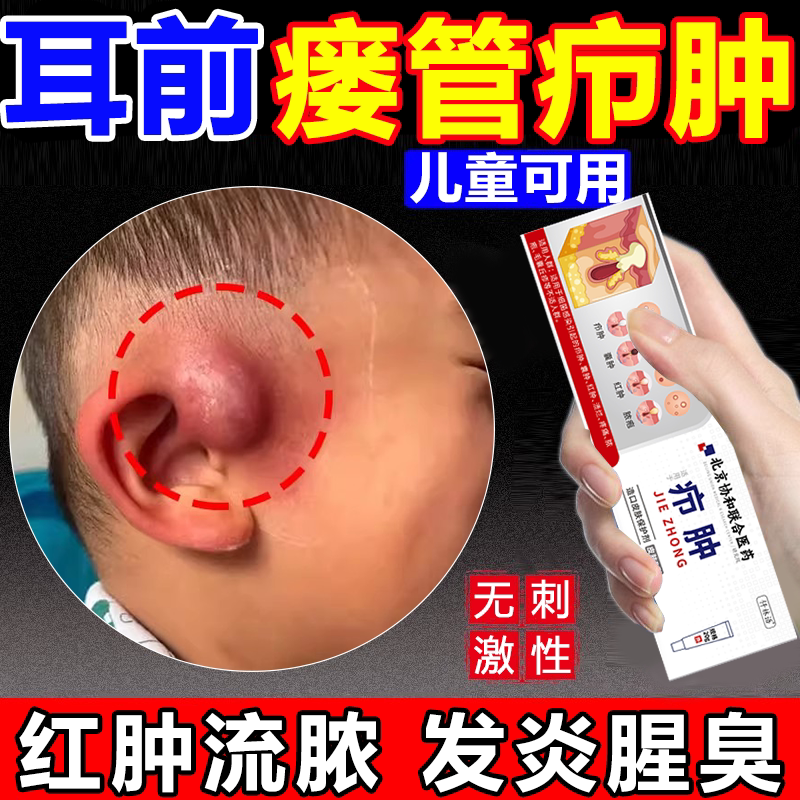 耳前瘘管耳瘘火疖子脓包疖肿硬块流脓耳仓发炎鼓包拔毒拔脓膏wg