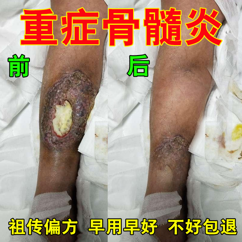 【祖传偏方】骨髓炎专用药膏化脓性骨头感染肿痛发热缓和溃烂抗菌