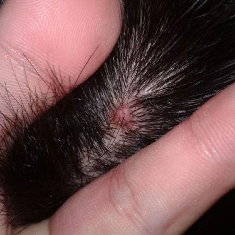头上长痘痘脓包疙瘩头癣毛囊炎脓疮毛囊发炎堵塞抑菌止痒消炎乳膏