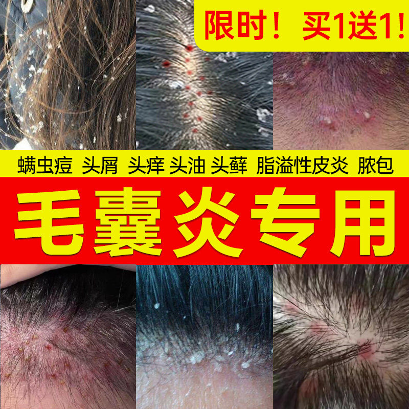 速发头囊炎脂溢痒去屑止性头上长痘痘