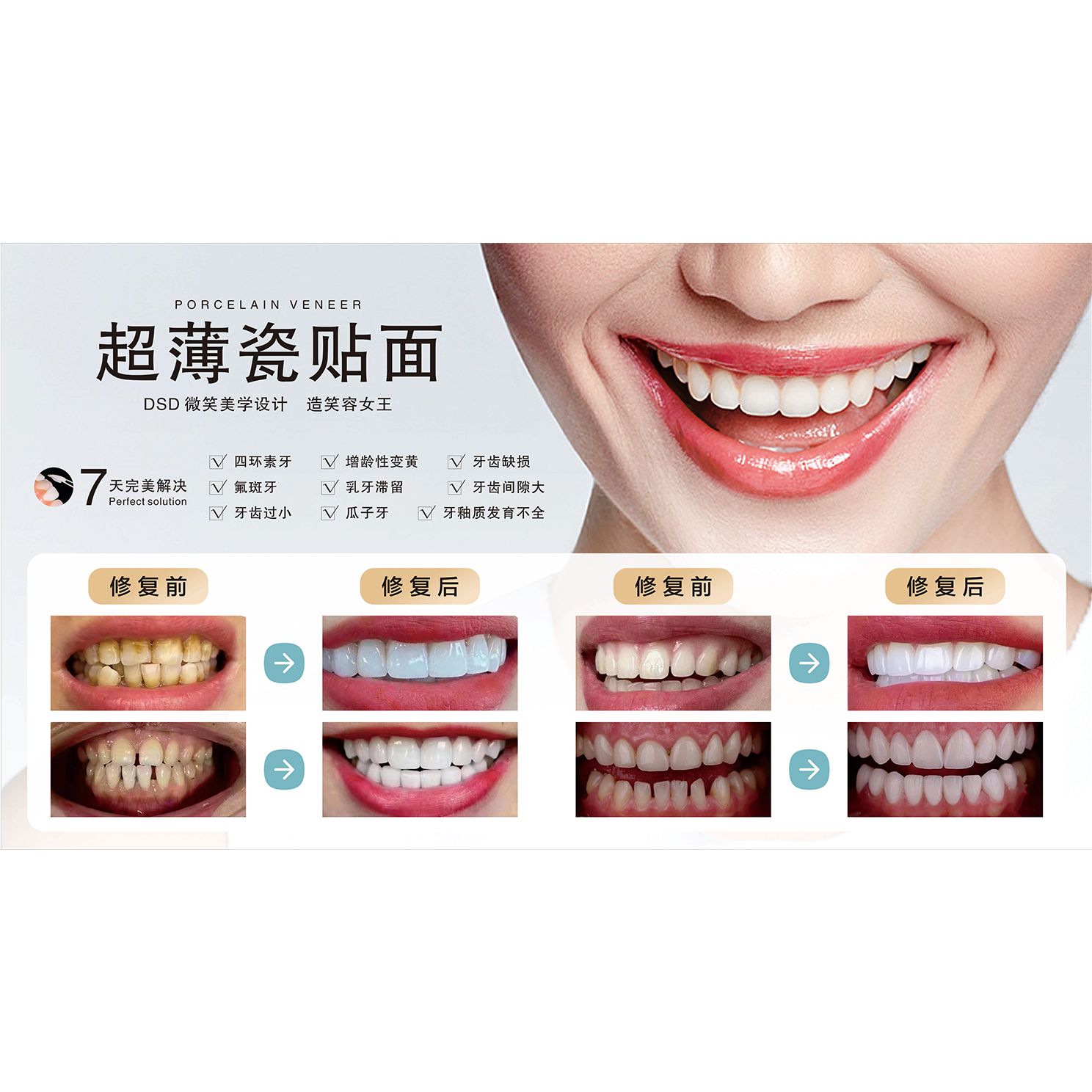 瓷贴面海报美白牙齿广告宣传画全其它印刷制品