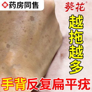 手背扁平疣去疣瘊除肉粒一抹无忧小肉粒疣软膏抗HPV生物凝胶OM