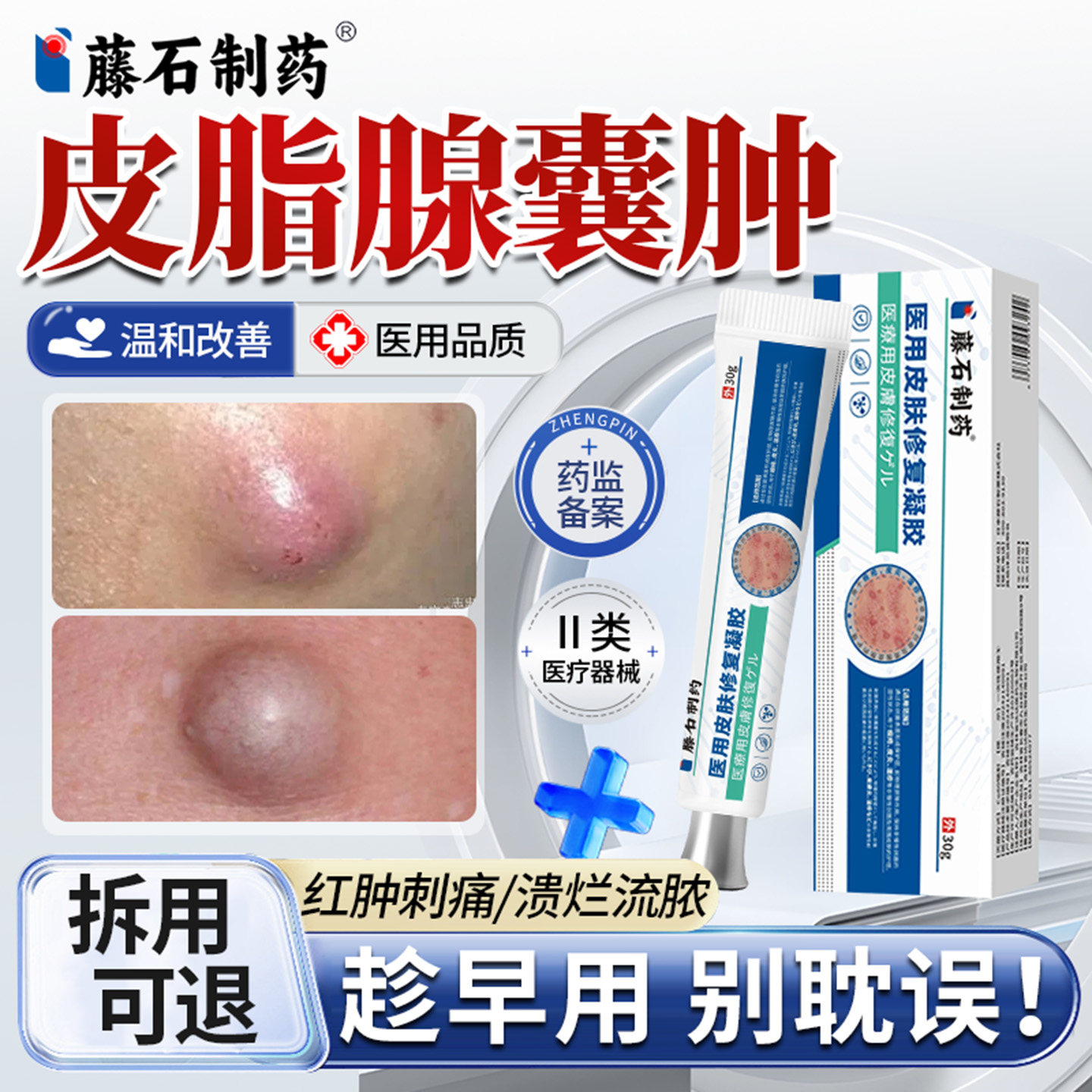 皮脂腺囊肿拔毒专用膏粉瘤痘痘去皮下肿硬块拔脓疖肿毛囊炎KP