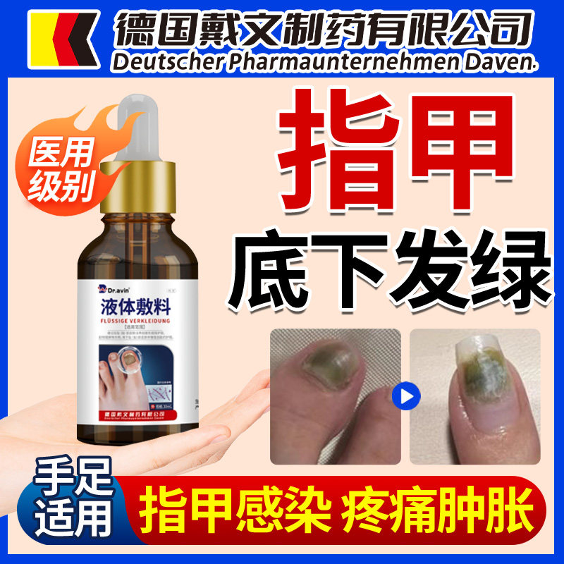 指甲绿脓杆菌变绿甲癣空甲床分离化脓发霉真菌感染抑菌药房同售FT