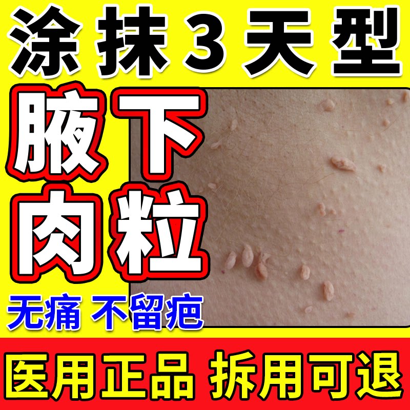 丝状疣腋下小肉粒疙瘩去除赘肉丝状疣瘊子腋窝去顽固疣zp