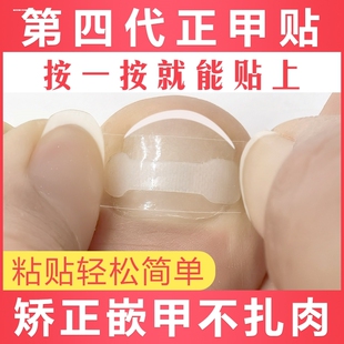 甲沟矫正器指甲矫正嵌甲神器纠正器脚趾甲贴片卷曲甲专用正甲扣炎