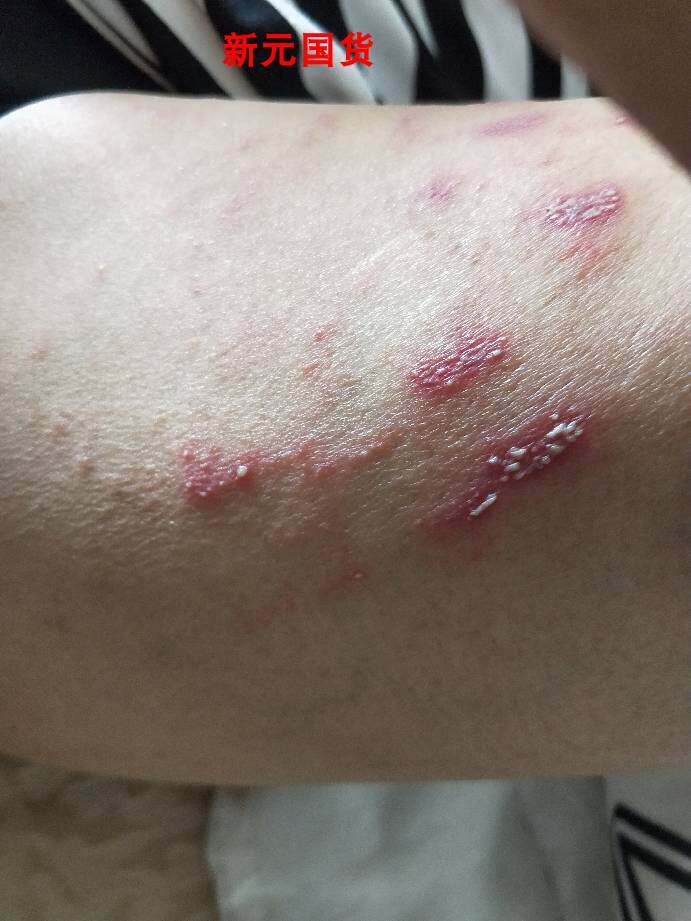 速发手臂小药点序诚中医膏孩肤宝儿童红小软膏
