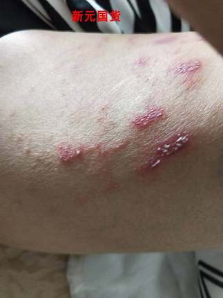 速发手臂小药点序诚中医膏孩肤宝儿童红小软膏