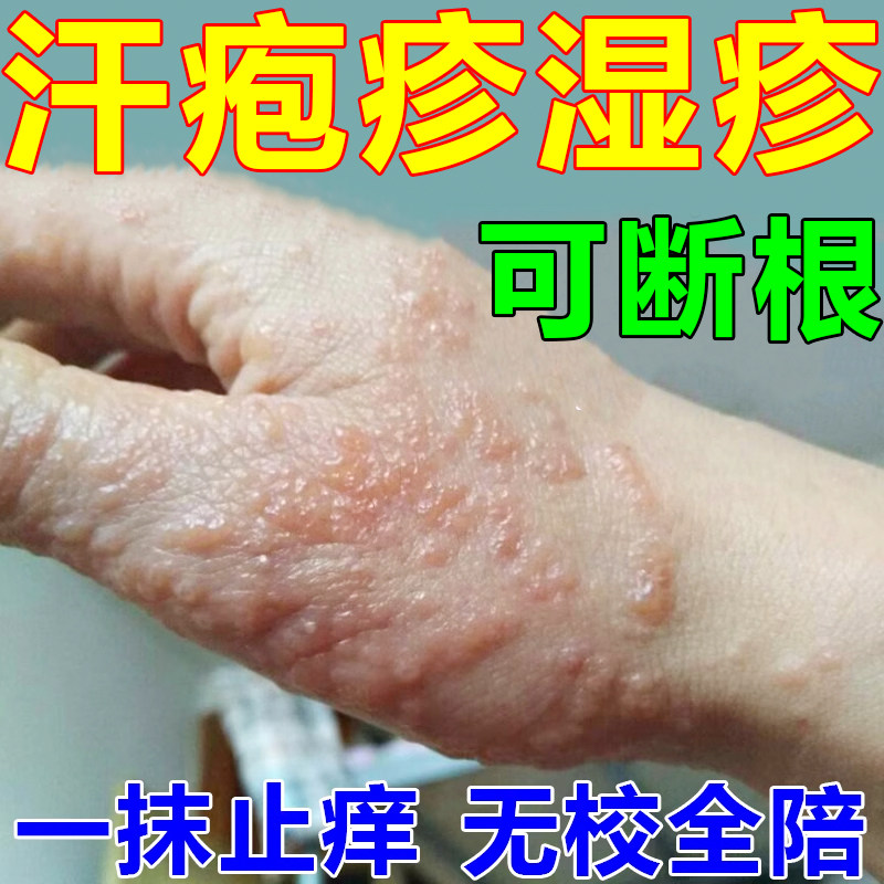 现货速发手上起小水泡汗状疱疹药脱皮止痒软膏汉状感染手气膏