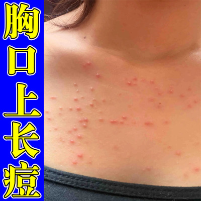 前胸后背长痘痘毛囊堵塞胸口起红肿脓包痘马拉色菌身上痒起红疙瘩
