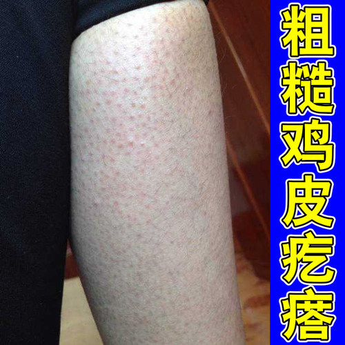 胳膊上鸡皮疙瘩粗糙毛孔堵塞黑点