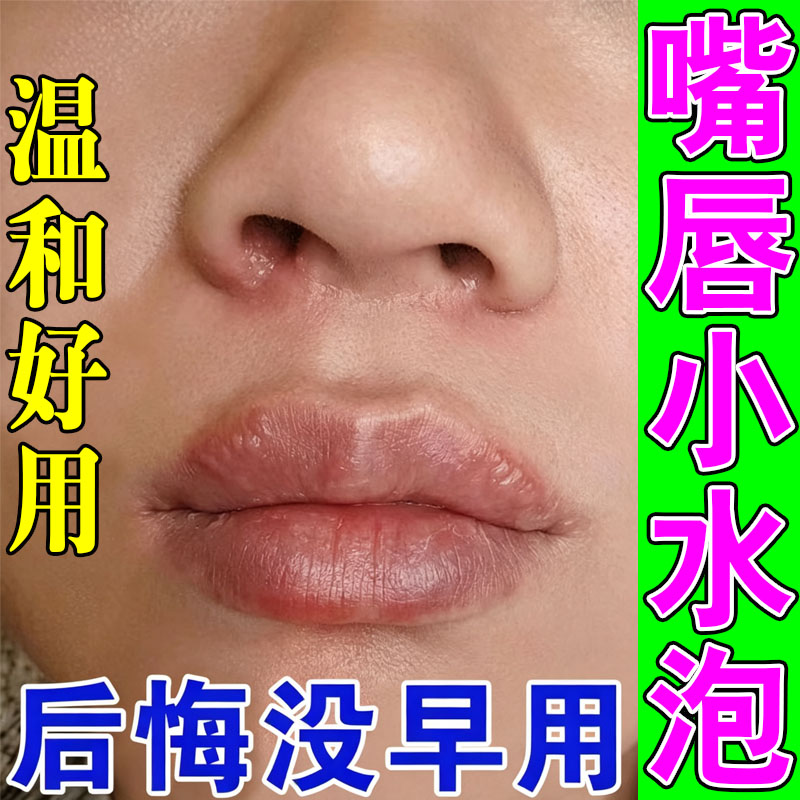 嘴唇水泡上火起水泡烂嘴角专用软皮肤消毒护理（消）