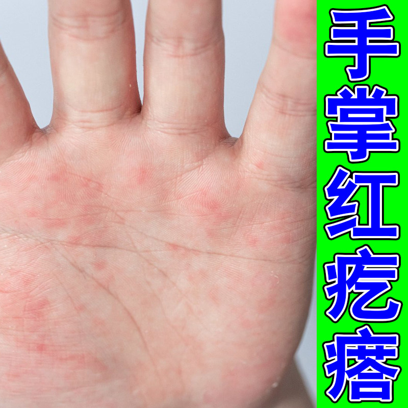 手心手掌疱红点刺痒脱皮真菌性手皮肤消毒护理（消）