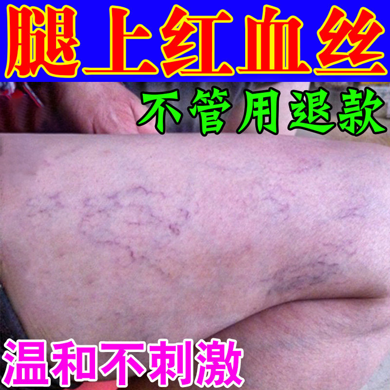 腿上脚踝有红血丝静脉曲张冷敷凝皮肤消毒护理（消）