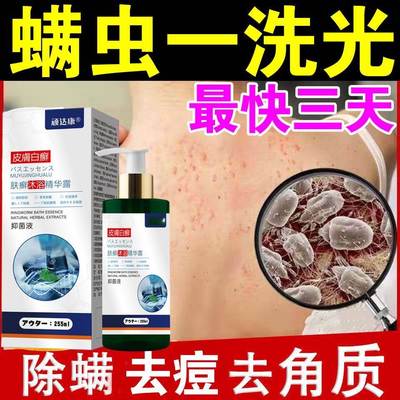 螨虫药膏人用背上长痘痘背部螨虫叮咬去除螨虫祛痘止痒神器