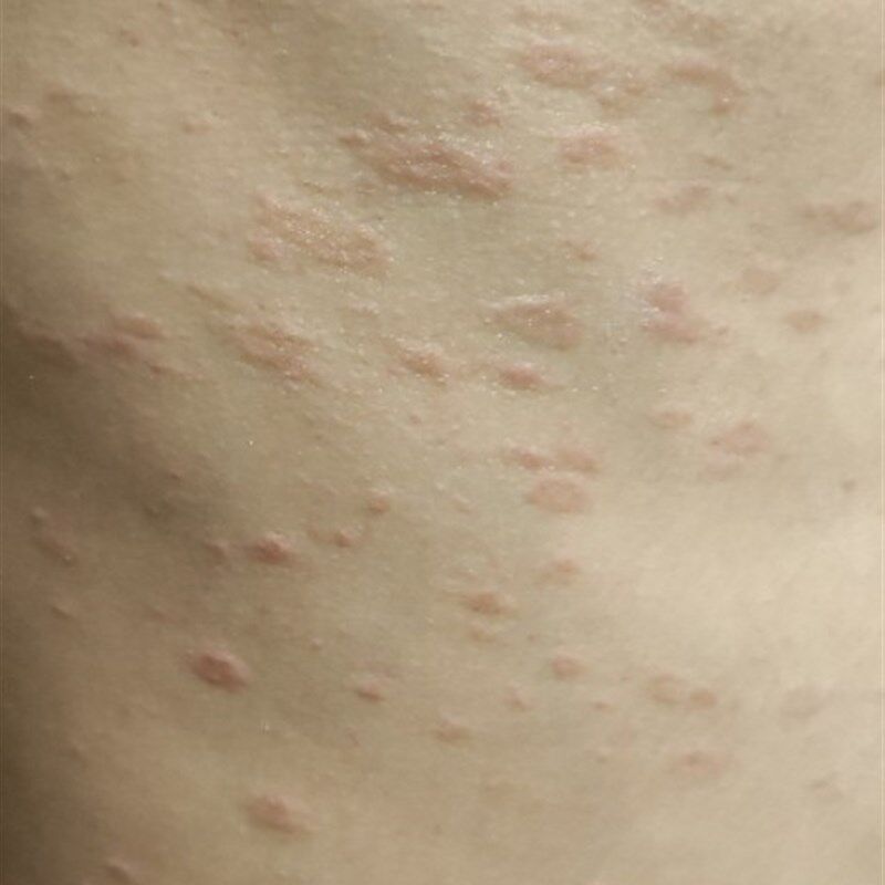 苗药毒鲜病皮肤专头皮手足脚体股藓