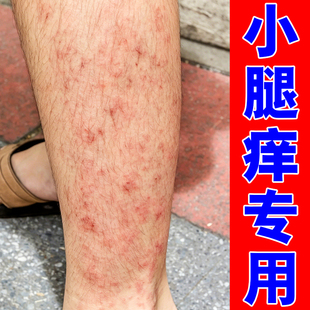 腿痒天热小腿痒起红疙瘩长红斑疹子红肿刺挠干燥起皮脱屑外用软膏