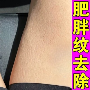 去肥胖纹修复霜生长纹消大腿学生去除男淡化纹路肥胖纹修复膏