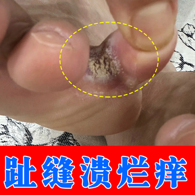 脚趾溃烂真菌脚气脚臭脚趾缝糜烂脱皮烂脚丫专用止痒脚部溃烂瘙痒