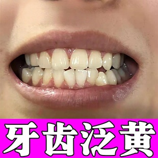 治牙黄口臭专用型茶渍牙斑烟渍牙垢牙结石牙膏