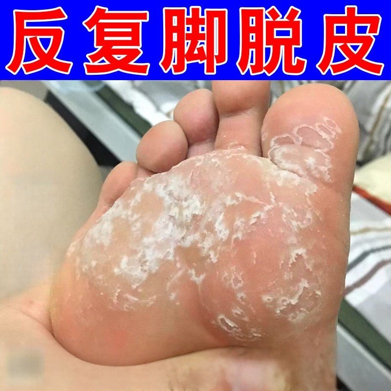 脚脱皮专用膏真菌感染脚裂脱皮脚上干燥蜕皮粗糙一抹修复乳膏,洗护清洁剂/卫生巾/纸/香薰,护手霜,淘宝优惠券,粉丝福利购,淘宝优惠卷