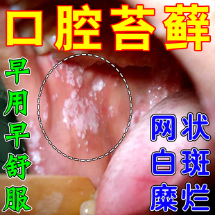 口腔扁平苔藓专用喷剂治疗黏膜修复膜纤维化白斑糜烂溃疡烂舌头药