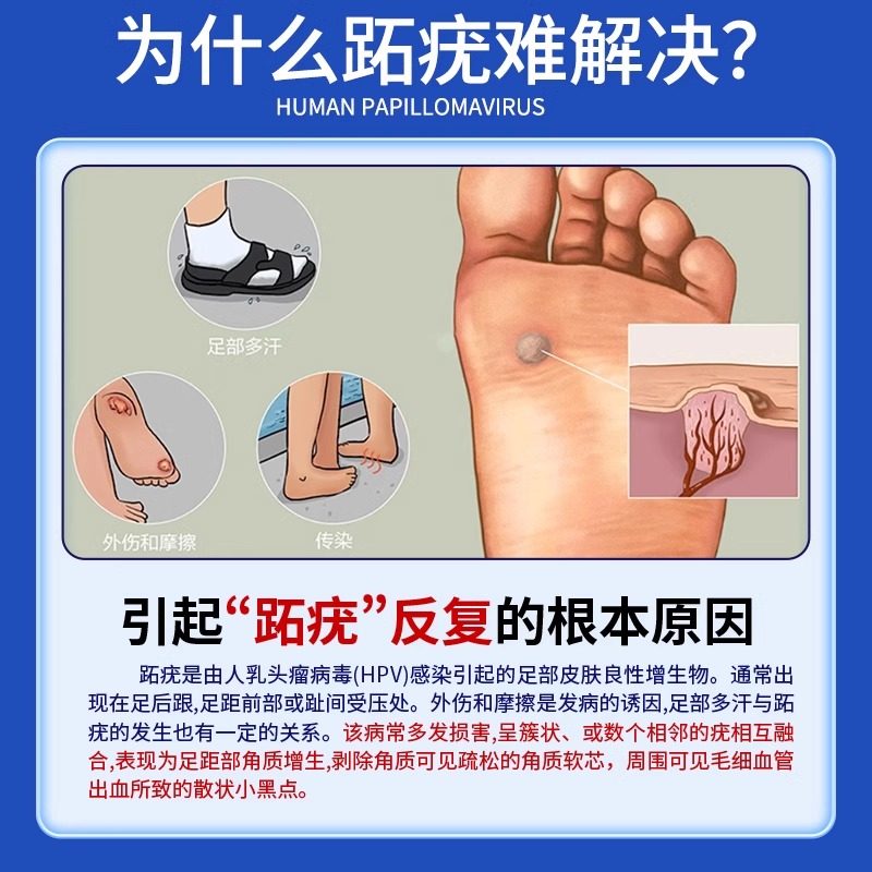 跖疣膏肉刺专用去足部脚底脚根长非鸡眼膏鸡眼贴水杨酸去除神器rw