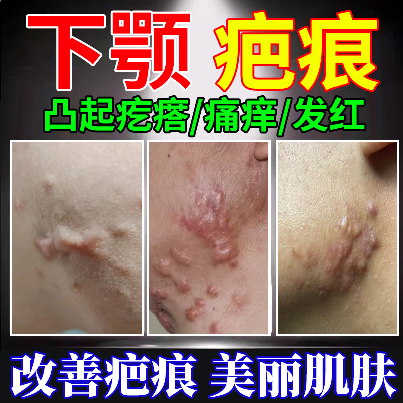 下颚疤痕增生凸起去除疙瘩修复凝胶贴烫伤烧伤软化针剖腹产留痕Q8