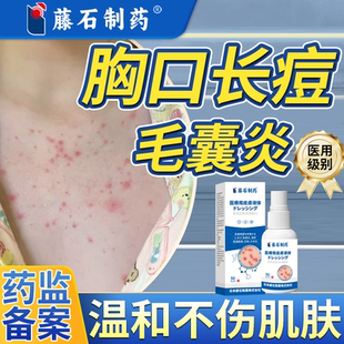 前胸口后背上长痘痘祛螨除菌毛囊炎温和不伤肤马拉色菌痘印瘙痒Q8