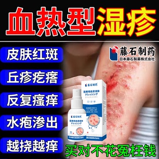 血热性型湿疹止皮肤瘙痒膏脱屑皮炎湿毒清过敏风团红斑真菌感染RW