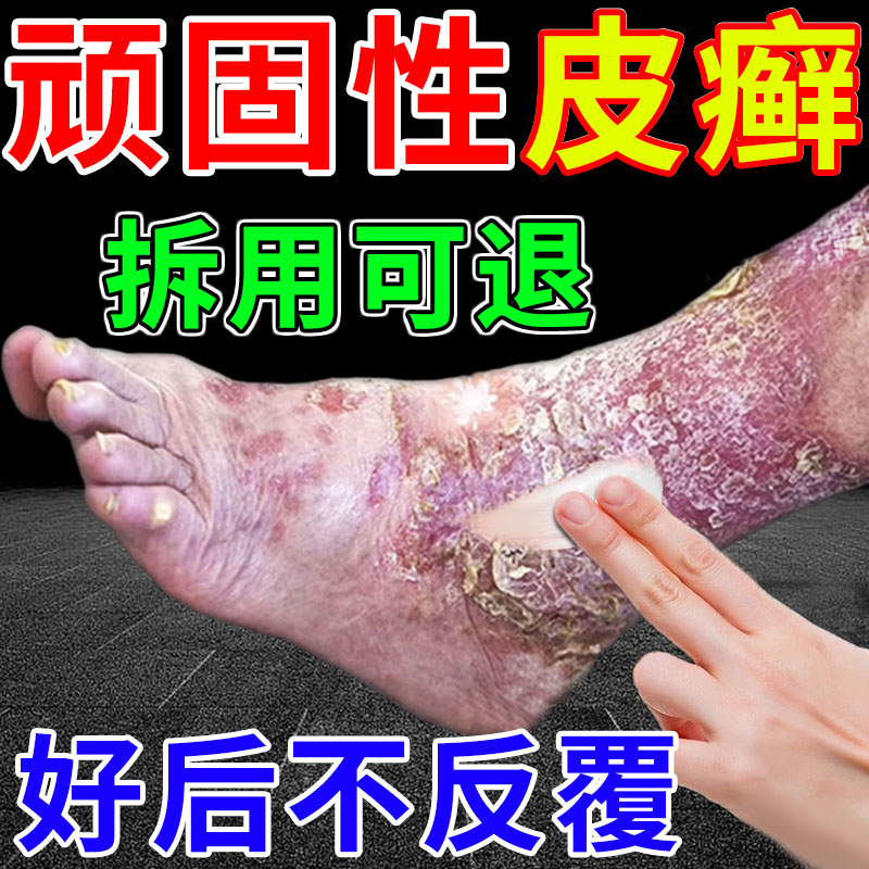 顽固性皮癣正品杀菌止痒外用皮肤廯藓毒痒克星牛皮鲜抑菌专用